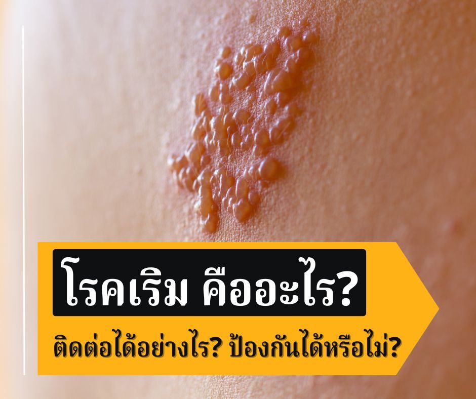โรคเริม คืออะไร? ติดต่อได้อย่างไร? ป้องกันได้หรือไม่?