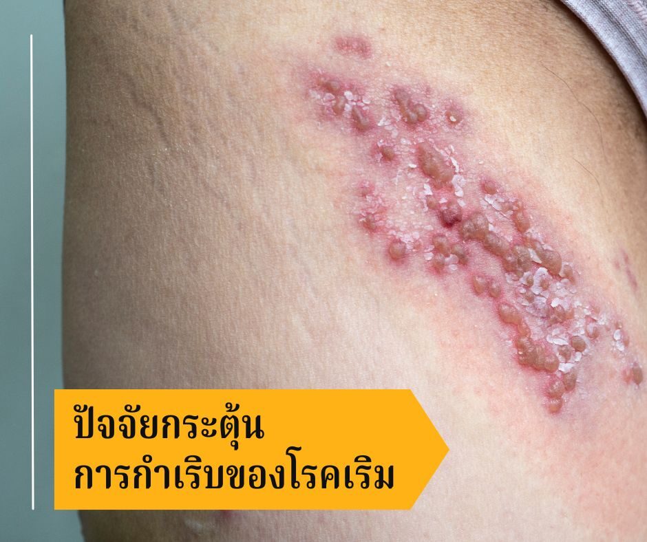 ปัจจัยกระตุ้นการกำเริบของโรคเริม