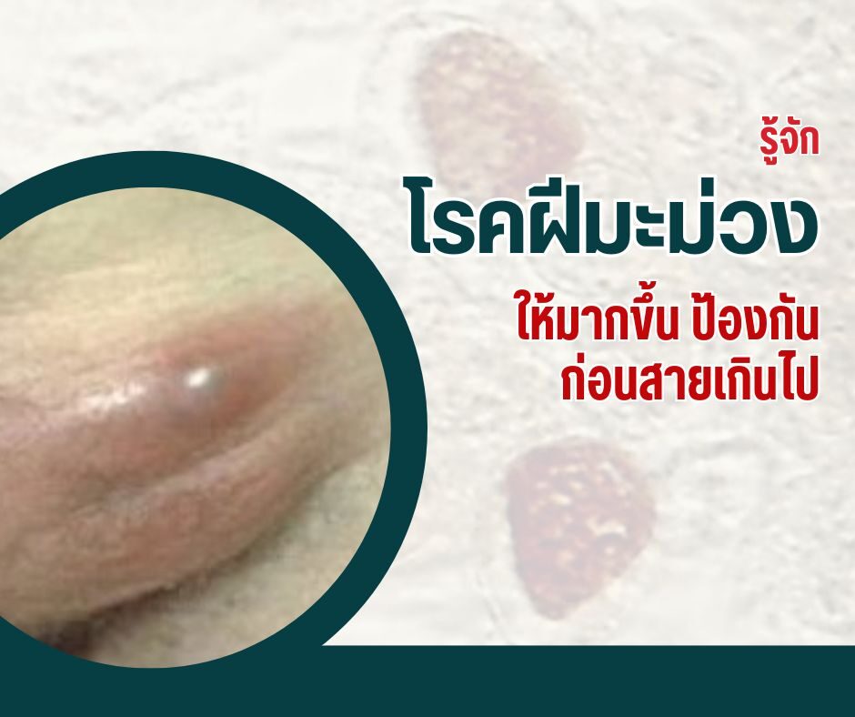 รู้จักโรคฝีมะม่วงให้มากขึ้น ป้องกันก่อนสายเกินไป