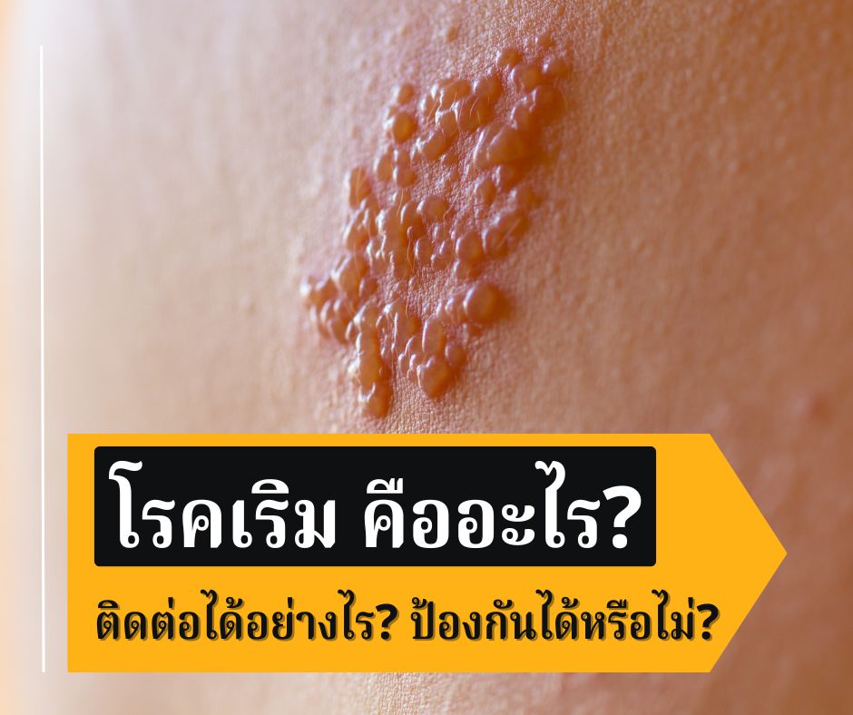 โรคเริม คืออะไร? ติดต่อได้อย่างไร? ป้องกันได้หรือไม่?