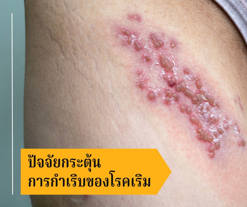 ปัจจัยกระตุ้นการกำเริบของโรคเริม