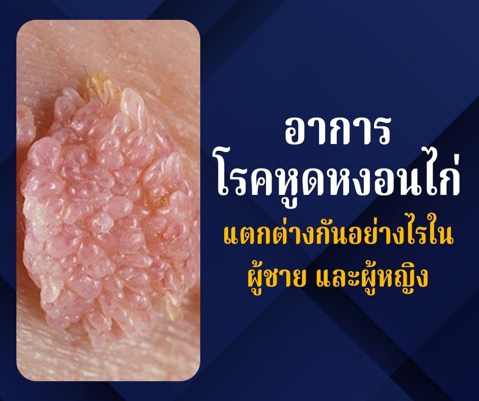 อาการโรคหูดหงอนไก่แตกต่างกันอย่างไรในผู้ชายและผู้หญิง