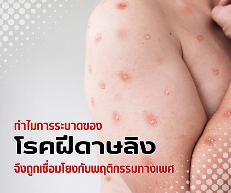 ทำไมการระบาดของโรคฝีดาษลิงจึงถูกเชื่อมโยงกับพฤติกรรมทางเพศ