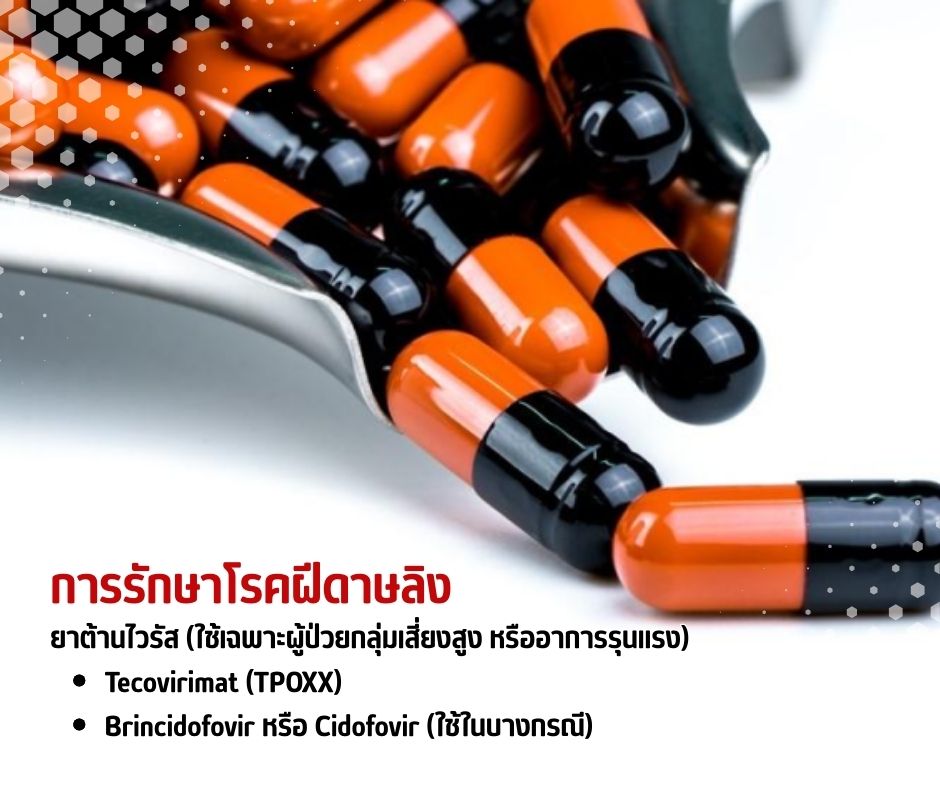 การรักษาโรคฝีดาษลิง