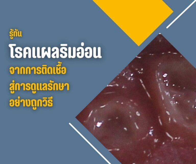 รู้ทันโรคแผลริมอ่อน จากการติดเชื้อสู่การดูแลรักษาอย่างถูกวิธี