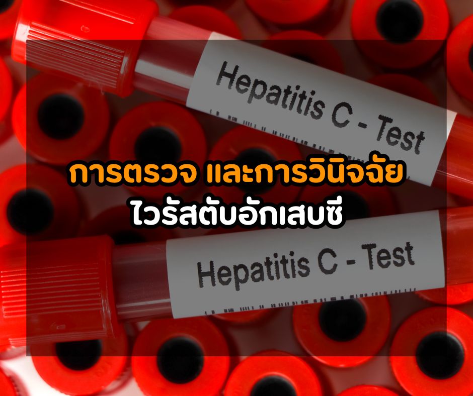 การตรวจ และการวินิจฉัยไวรัสตับอักเสบซี