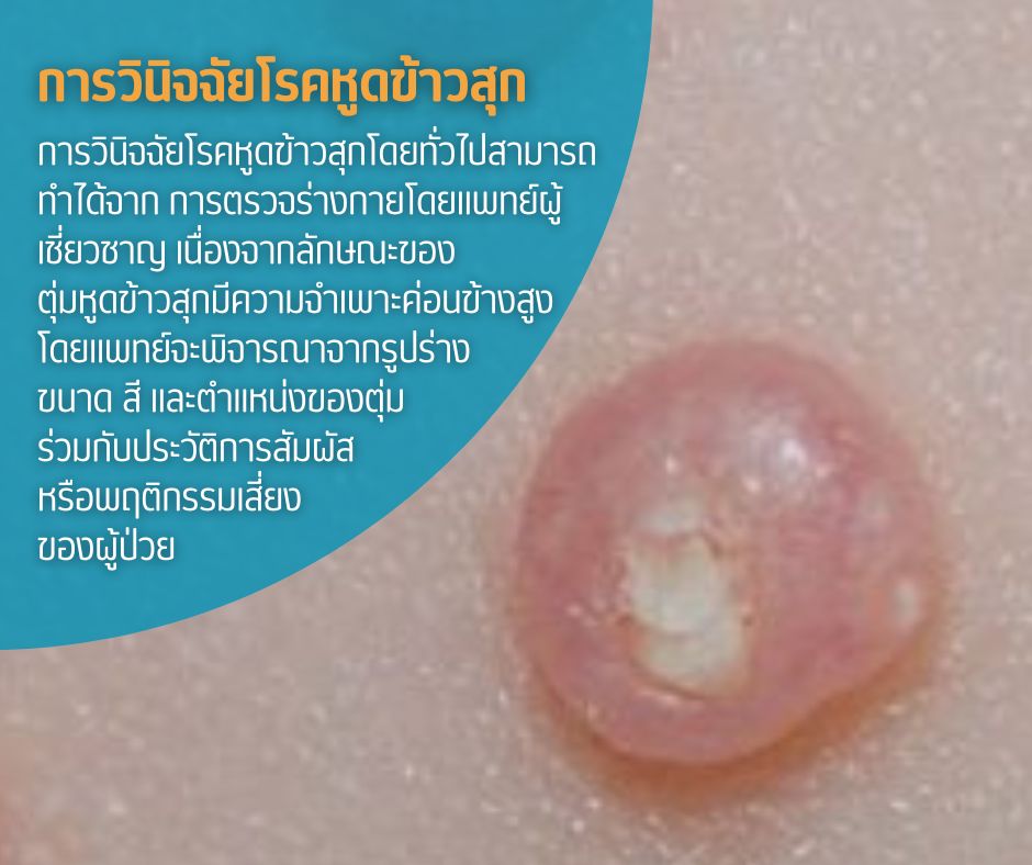 การวินิจฉัยโรคหูดข้าวสุก